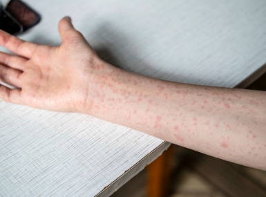 measles