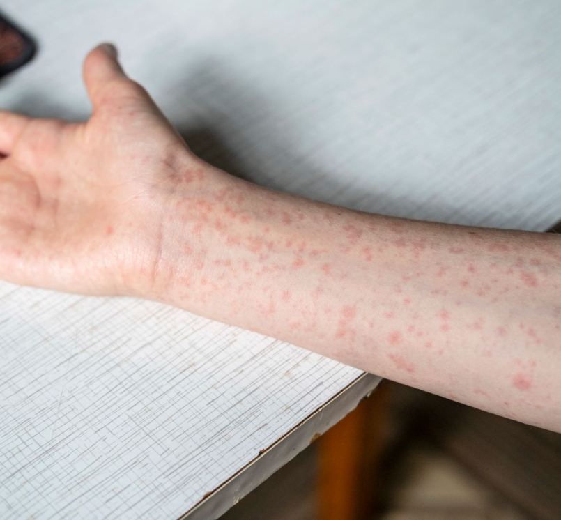 measles