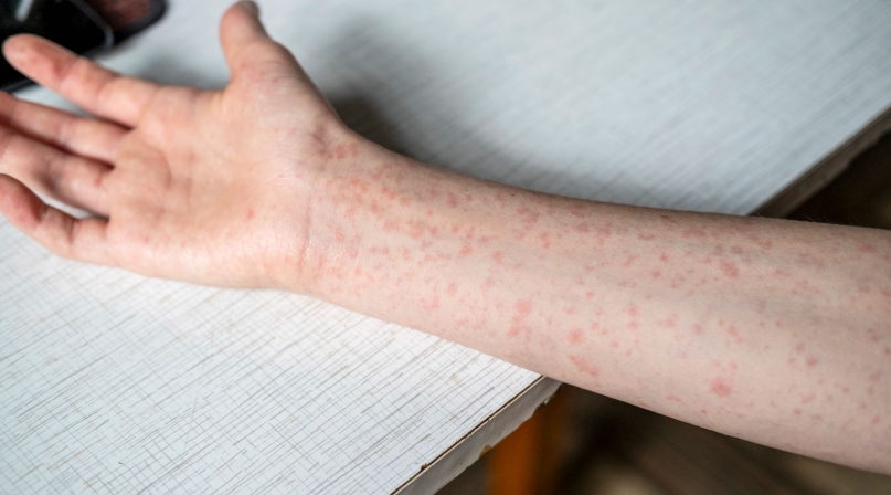 measles
